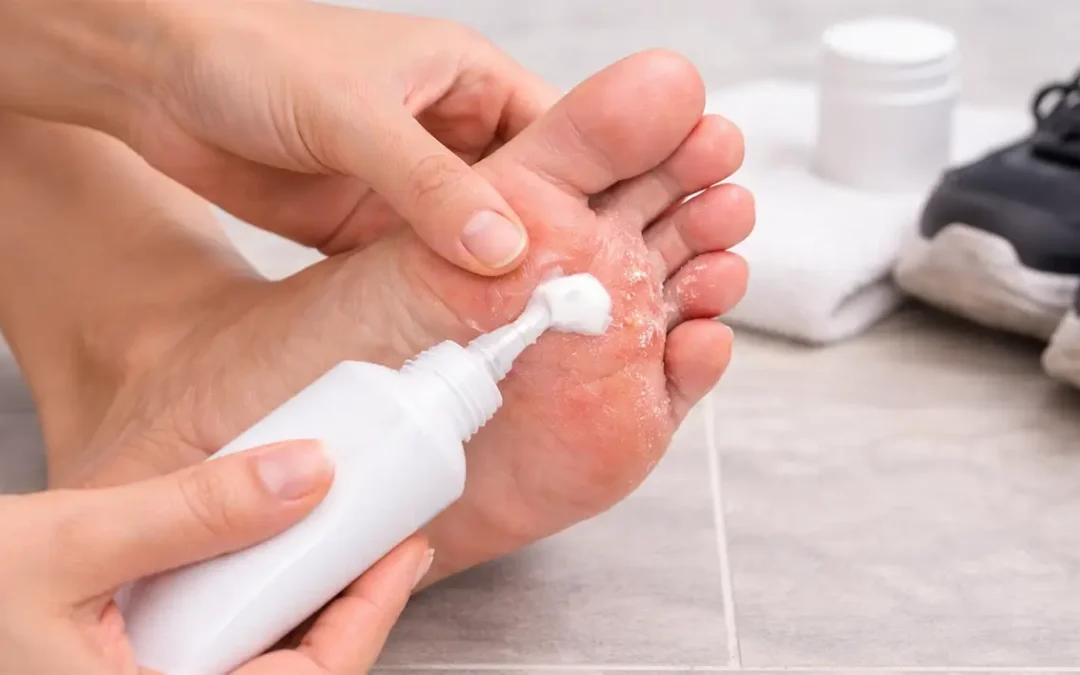 Antifungal Cream for Athlete’s Foot: What Works (and How to Stop It from Coming Back)