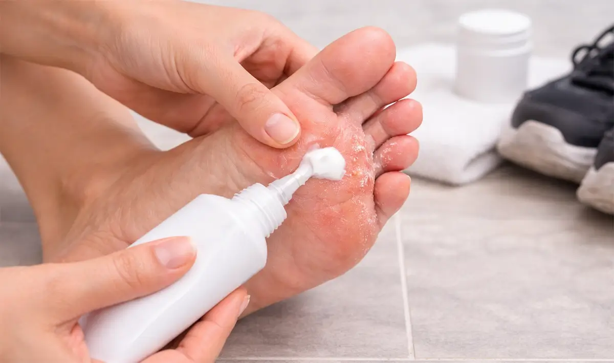 Hand applying antifungal cream to the bottom of a foot to treat athlete’s foot caused by sweaty feet